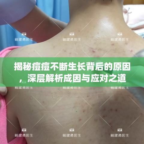 揭秘痘痘不斷生長背后的原因，深層解析成因與應(yīng)對之道